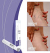 Portable Spider Vein Removal Pen