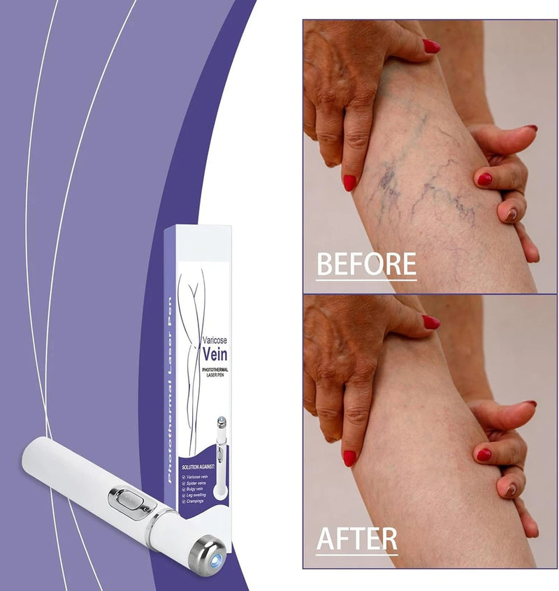 Portable Spider Vein Removal Pen